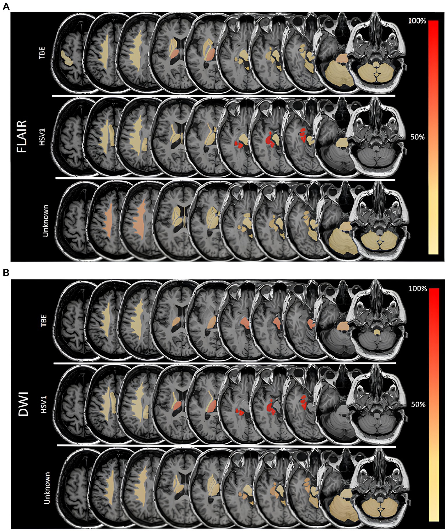 Magnetic resonance imaging in acute meningoencephalitis of viral and unknown origin: frequent findings and prognostic potential